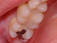 臼歯を接写2
